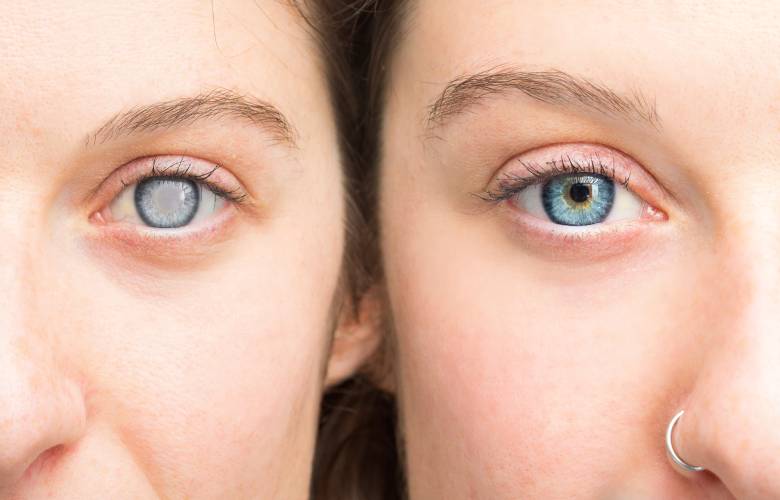 Twee blauwe ogen. De ene vrouw haar oog is goed maar de andere vrouw heeft cataract.