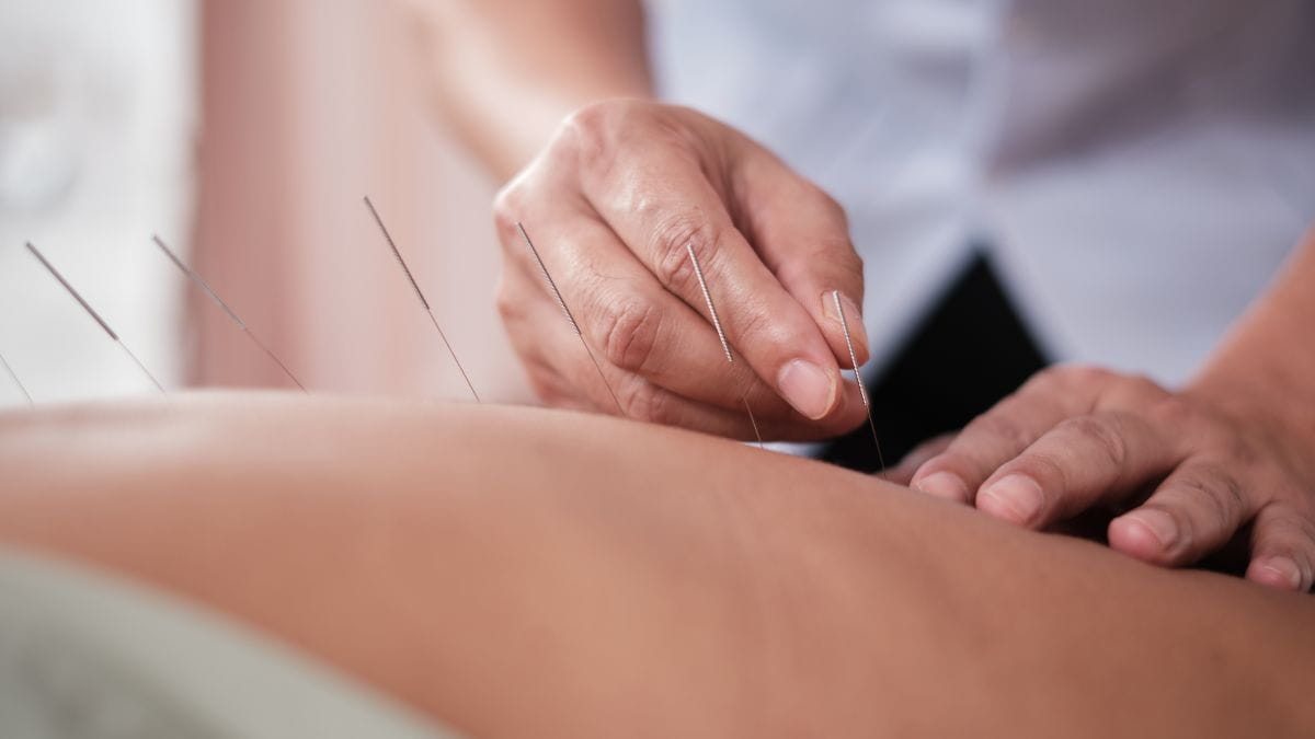 Closeup van acupunctuurnaalden die in de rug worden geplaatst tijdens een acupunctuurbehandeling in België