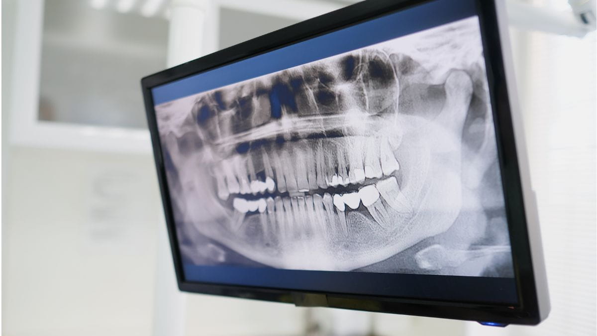 Röntgenfoto van een gebit vóór orthodontie terugbetaling.